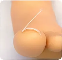 矯正具を装着する施術